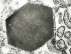 F,1y. | Charcot-Leyden crystal - histiocytosis X F,1y. | Charcot-Leyden crystal - histiocytosis X